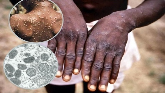 🎧 Afecta acceso a las vacunas enfrentamiento a viruela del mono en Nigeria