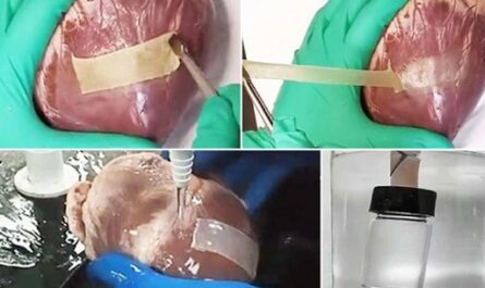 Un nuevo parche de hidrogel doble cara podría reparar eficientemente corazones infartados