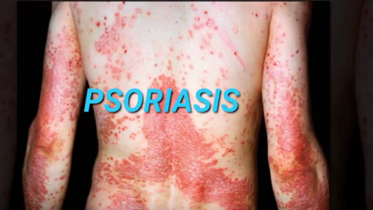 📹 Psoriasis