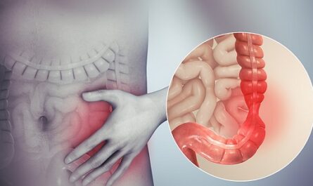 Síndrome del intestino irritable