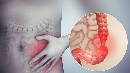 Síndrome del intestino irritable