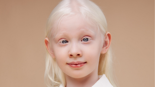 Realizan en Cienfuegos pesquisa sobre el albinismo