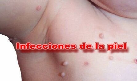 Infecciones en la piel