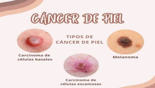 Mantiene Cienfuegos cáncer de piel como primer padecimiento oncológico 